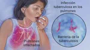 Cuauht&eacute;moc registra 16 casos de tuberculosis, 6 muertes